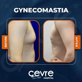 Vorher-nachher-Ergebnis Gynäkomastie-OP bei Adem and Havva Medical Center, Brustkontur