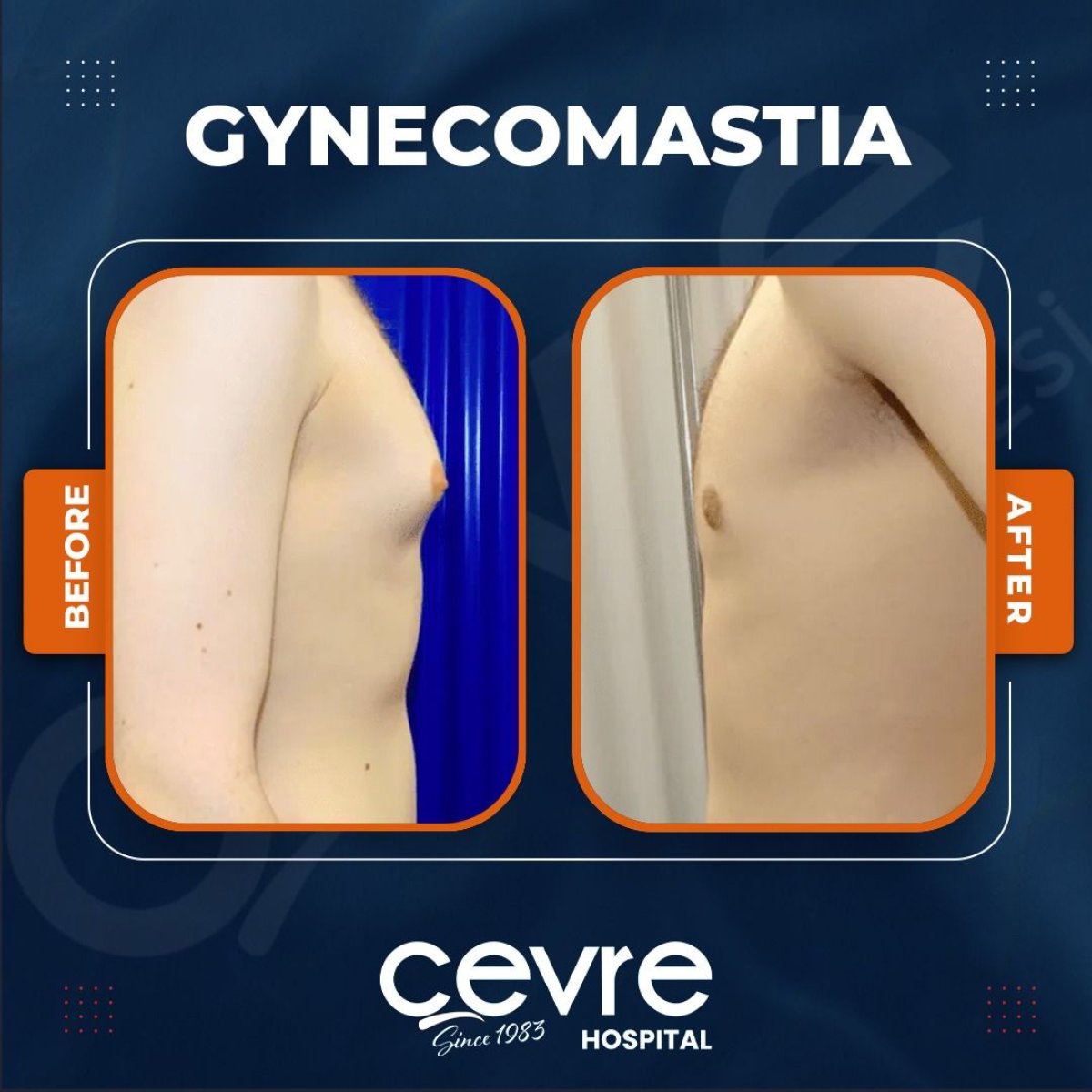 Resultados antes y después de cirugía de ginecomastia en Adem and Havva Medical Center, contorno de pecho