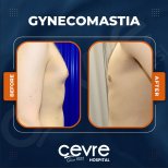 Vorher-nachher-Ergebnisse der Gynäkomastie-OP bei Adem and Havva Medical Center, Brustkontur