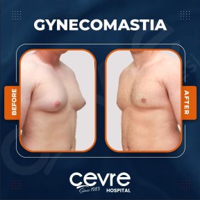 Vorher-nachher-Ergebnis Gynäkomastie-OP bei Adem and Havva Medical Center, Brustkontur