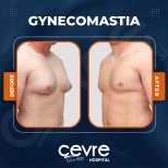 Vorher-nachher-Ergebnis Gynäkomastie-OP bei Adem and Havva Medical Center, Brustkontur