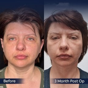 Before and after neck lift results at Dr. Safa Manav Clinic, visible jawline and neck contour