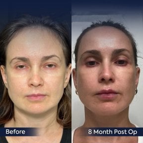 Neck lift before and after results at Dr. Safa Manav Clinic, 8 months post-op facial rejuvenation