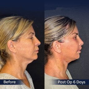 Before and after neck lift results at Dr. Safa Manav Clinic, visible neck contour improvement