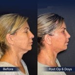 Before and after neck lift results at Dr. Safa Manav Clinic, visible neck contour improvement