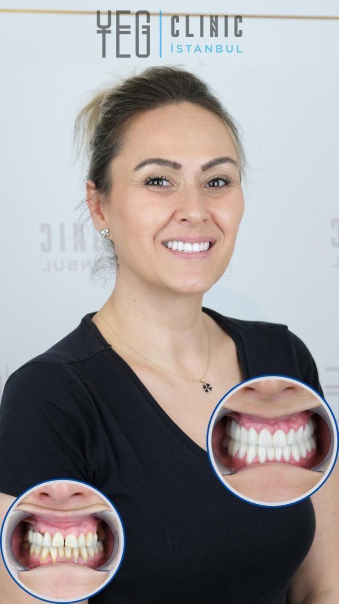 نتائج قبل وبعد تركيب تيجان البورسلين في YEG Clinic – تحول الابتسامة
