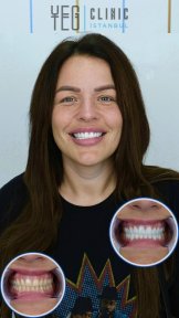Vorher-nachher-Ergebnisse der Porzellankronen bei YEG Clinic, sichtbare Smile-Transformation