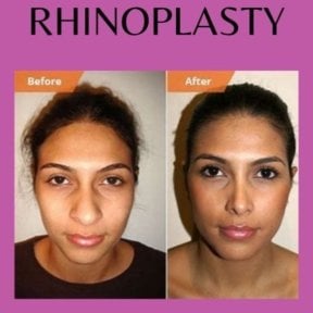 Before and after bulbous nose rhinoplasty results at ID Clinic Bangkok, refined nose shape