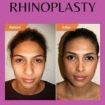 Before and after bulbous nose rhinoplasty results at ID Clinic Bangkok, refined nose shape