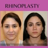 Before and after bulbous nose rhinoplasty results at ID Clinic Bangkok, refined nose shape