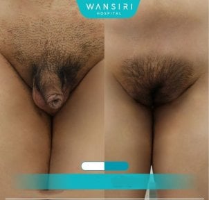 Before and after male to female (MTF) surgery results at Wansiri Hospital, genital transformation