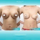 Before and after breast lift results at Wansiri Hospital, improved breast contour after 7 months