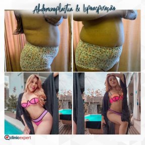 Before and after tummy tuck results at CE International Hospital, visible body contour improvement
