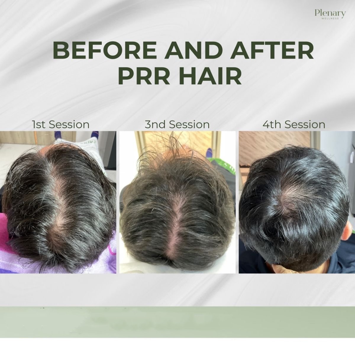 Résultats avant et après traitement PRP contre la perte de cheveux chez Plenary Wellness