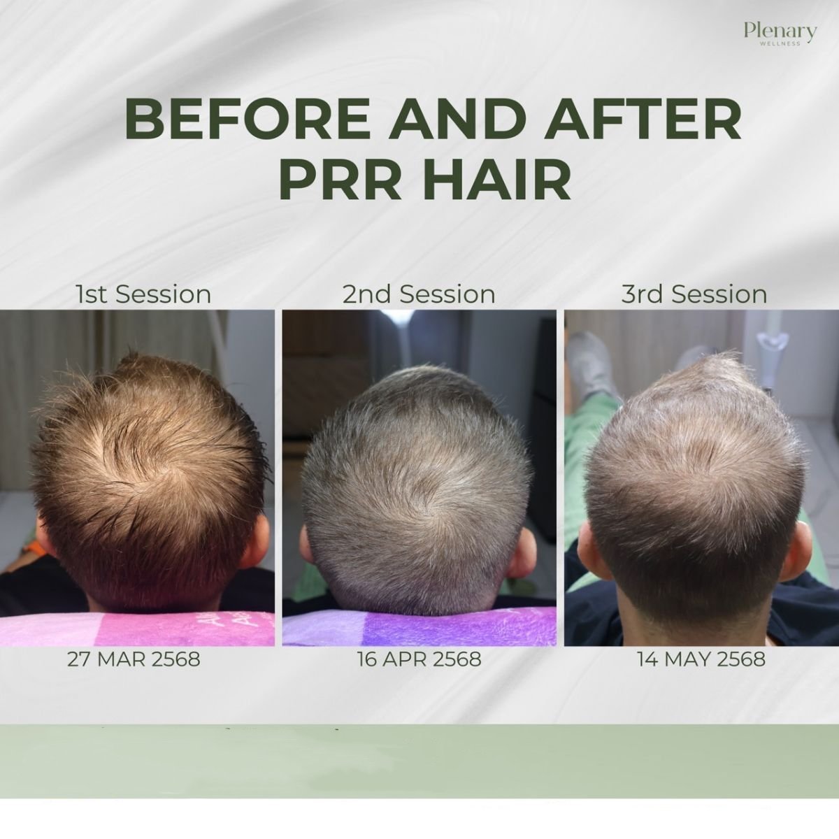 Avant/après traitement PRP contre la perte de cheveux chez Plenary Wellness – densité accrue