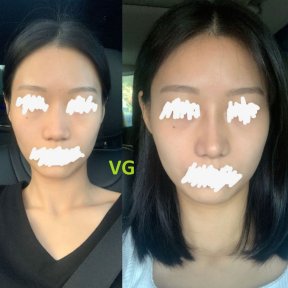 Vorher-nachher-Ergebnisse der Alarplastik bei VG Plastic Surgery, Nasenflügelkorrektur