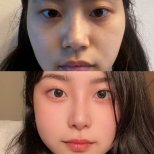 Vorher-nachher-Ergebnis der Alarplastik bei VG Plastic Surgery, verfeinerte Nasenflügel