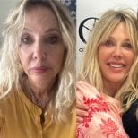 Before and after blepharoplasty results at Marroquín & Sandoval Plastic Surgery Clinic