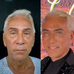 Before and after blepharoplasty results at Marroquín & Sandoval Plastic Surgery Clinic