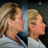Before and after blepharoplasty results at Marroquín & Sandoval Plastic Surgery Clinic