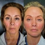 Blepharoplasty before and after results at Marroquín & Sandoval Plastic Surgery Clinic, eyelid lift