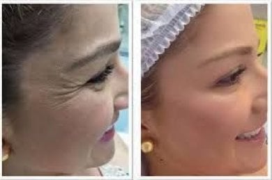 Vorher-nachher-Ergebnis Botox bei Odontoliuzzi Dentistry and Health, weniger Augenfalten