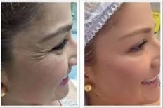 Vorher-nachher-Ergebnis Botox bei Odontoliuzzi Dentistry and Health, weniger Augenfalten