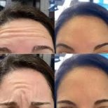 Vorher-nachher Botox-Injektionen bei Odontoliuzzi Dentistry and Health, glatte Stirn