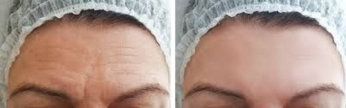 نتائج تقليل تجاعيد الجبهة قبل وبعد حقن البوتوكس في Odontoliuzzi Dentistry and Health