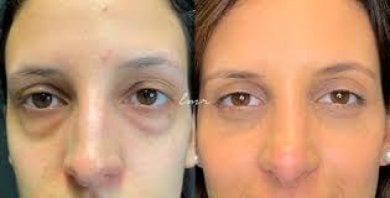 Before and after blepharoplasty results at Odontoliuzzi Dentistry and Health, eyelid correction