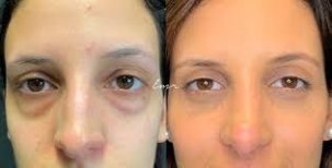 Before and after blepharoplasty results at Odontoliuzzi Dentistry and Health, eyelid correction