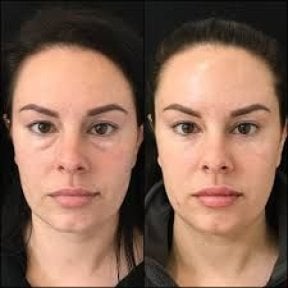 Blepharoplasty before and after results at Odontoliuzzi Dentistry and Health, eyelid correction