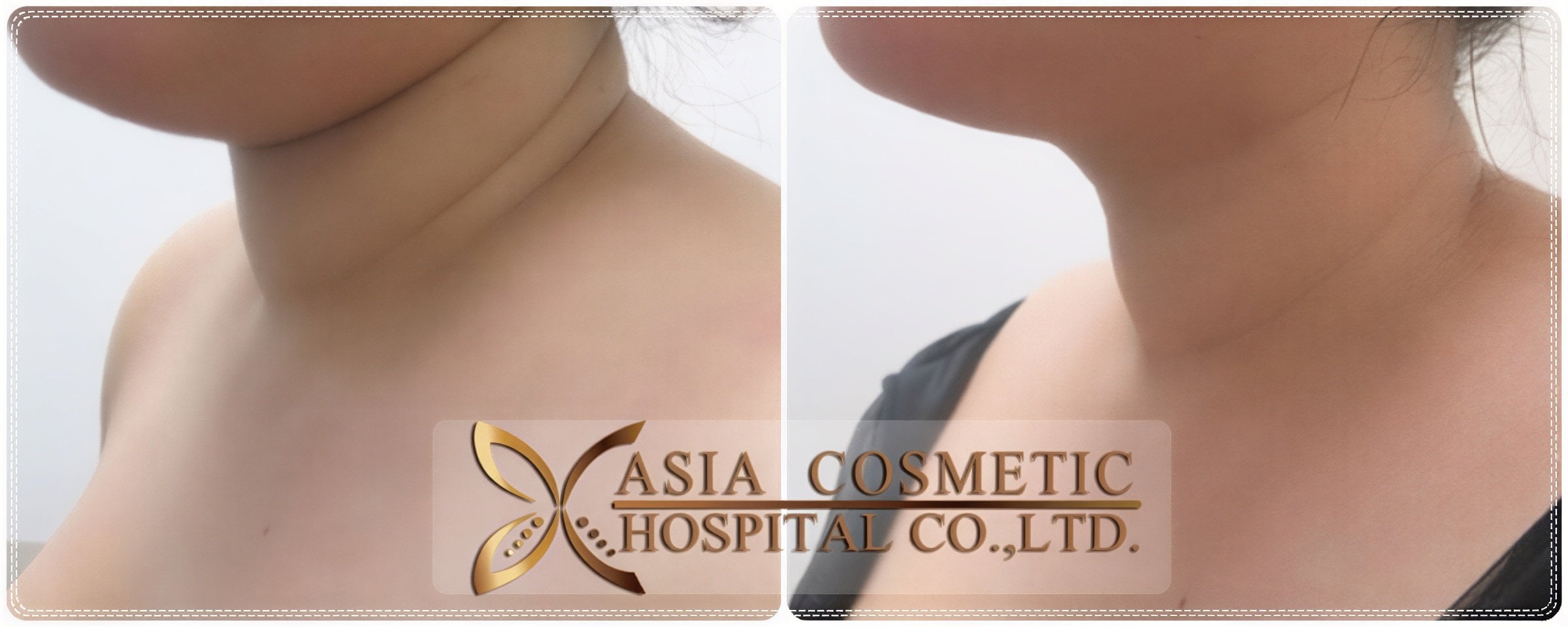 نتائج شفط دهون الذقن قبل وبعد في Asia Cosmetic Hospital، تحديد الفك المحسن