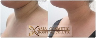Vorher-nachher-Ergebnis Kinn-Liposuktion bei Asia Cosmetic Hospital, verbesserte Kontur