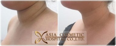Vorher-nachher-Ergebnis Kinn-Liposuktion bei Asia Cosmetic Hospital, verbesserte Kontur