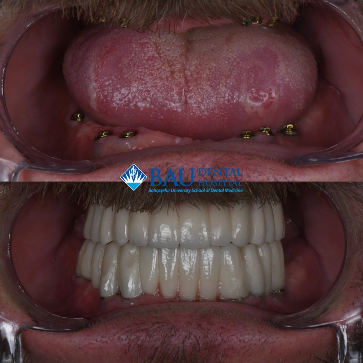 نتيجة قبل وبعد زراعة الأسنان All-on-6 في مستشفى Bahçeşehir University Dental Hospital