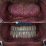 Resultados antes y después de implantes All-on-6 en Bahçeşehir University Dental Hospital