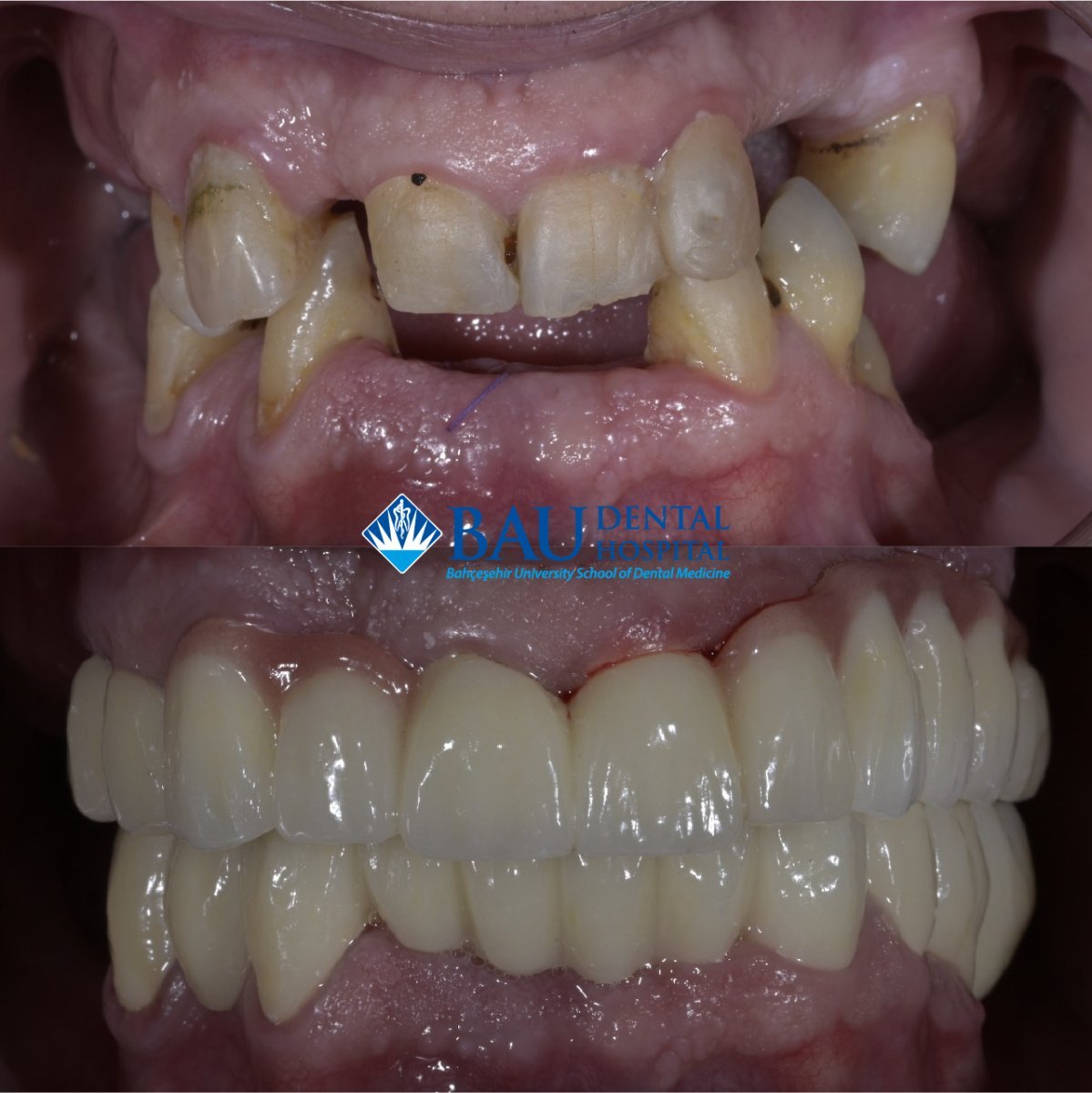 Antes y después de carillas en Bahçeşehir University Dental Hospital, resultado de sonrisa