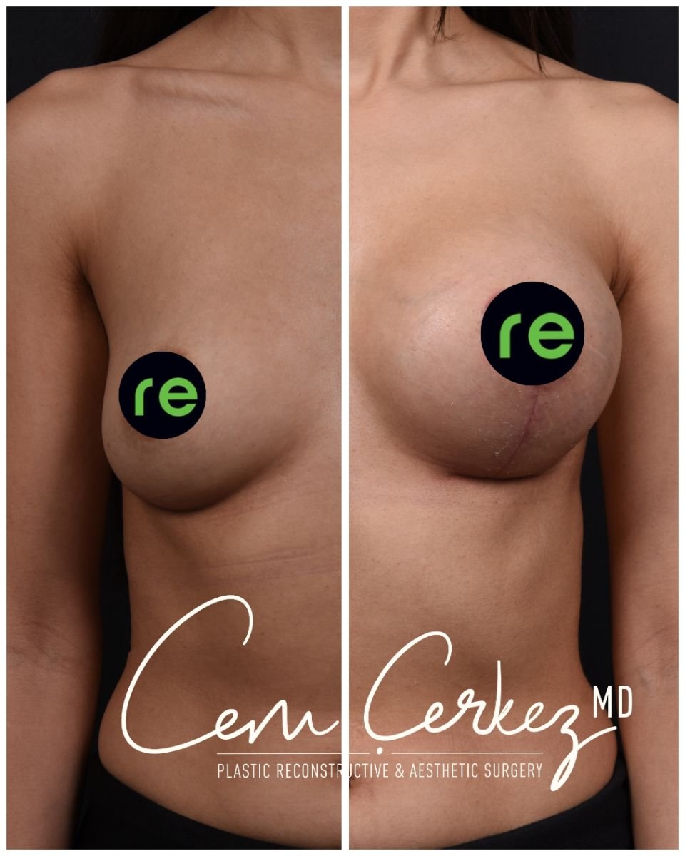 نتائج قبل وبعد تكبير ورفع الثدي في RENOVIUM CLINIC BY CEM CERKEZ MD