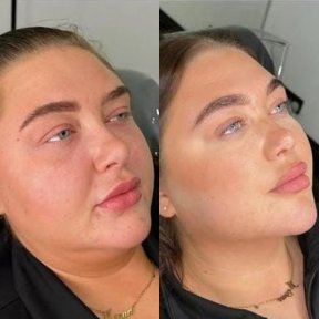 Vorher-nachher-Ergebnis Morpheus8 Hautstraffung bei Adem and Havva Medical Center, glattere Haut