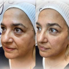 Vorher-nachher-Ergebnis Morpheus8 Hautstraffung bei Adem and Havva Medical Center, glattere Haut