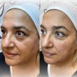 Vorher-nachher-Ergebnis Morpheus8 Hautstraffung bei Adem and Havva Medical Center, glattere Haut