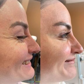 Vorher-nachher-Ergebnis Morpheus8 Hautstraffung bei Adem and Havva Medical Center, glattere Haut