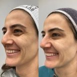 Vorher-nachher-Ergebnis Morpheus8 Hautstraffung bei Adem and Havva Medical Center, weniger Falten