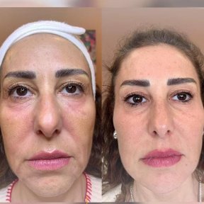 Vorher-nachher-Ergebnis Morpheus8 Hautstraffung im Gesicht bei Adem and Havva Medical Center