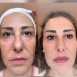 Vorher-nachher-Ergebnis Morpheus8 Hautstraffung im Gesicht bei Adem and Havva Medical Center