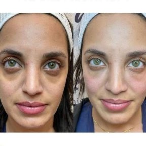 Vorher-nachher-Ergebnis Morpheus8 Hautstraffung im Gesicht bei Adem and Havva Medical Center