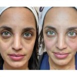 Vorher-nachher-Ergebnis Morpheus8 Hautstraffung im Gesicht bei Adem and Havva Medical Center