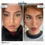 Before and after bichectomy results at CE International Hospital, slimmer cheeks visible