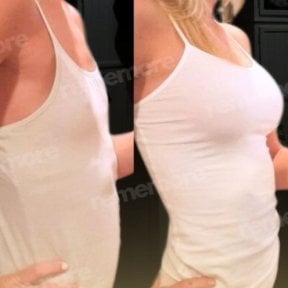 Before and after mammoplasty results at Memorial Şişli Hospital, visible breast enhancement